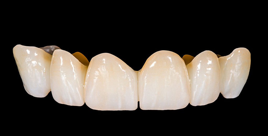 Ajustarse ensayo dividir Qué material es el mejor para una prótesis dental?